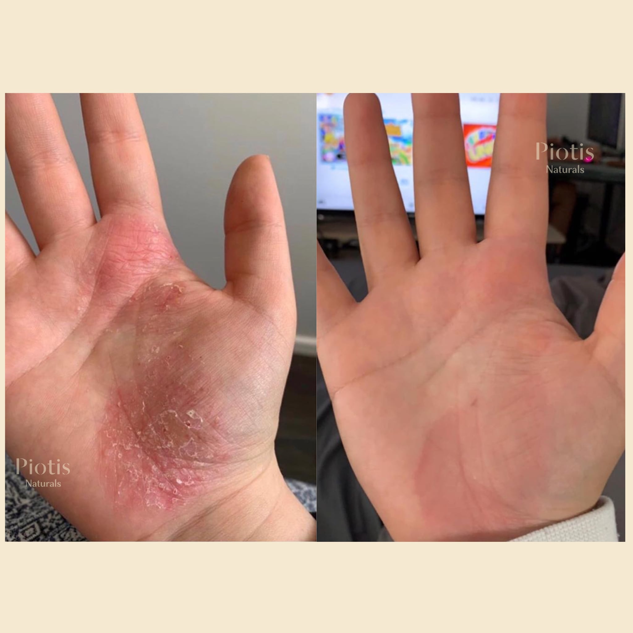 DRY SKIN