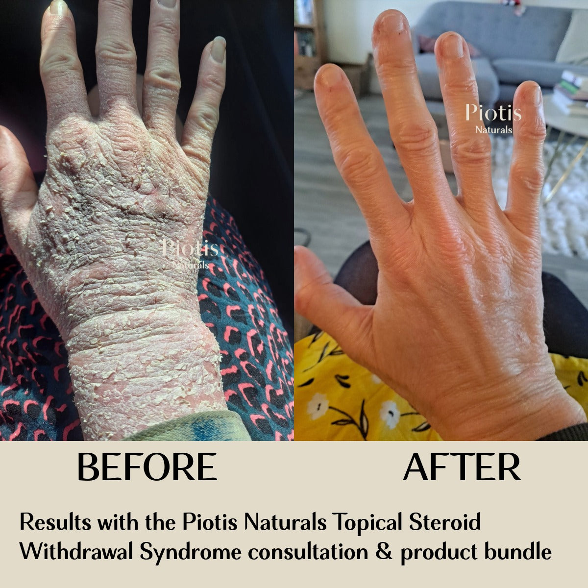 Before and after comparison of a hand treated with Piotis Naturals topical steroid withdrawal syndrome consultation and product bundle.

natural Topical Steroid Withdrawal Syndrome treatment, natural eczema cream, natural weeping eczema cream, Dr Evanthia Samota, skincare coaching for eczema and tsw, vegan eczema skincare, cruelty-free eczema cream, tsw